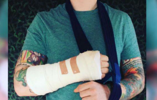 El cantante Ed Sheeran anunció que se ha fracturado el brazo derecho